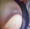 20��Ů�������ҧ�ˣ������ʼ������������쳣����鷢��˫��ȫ�׽�ICU